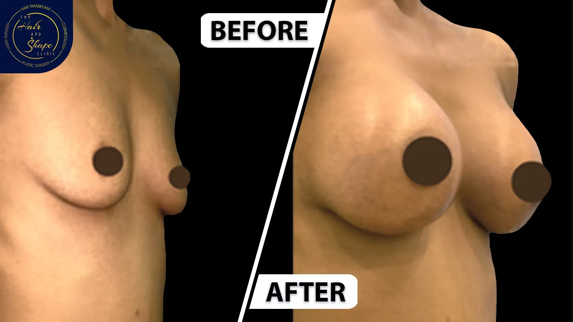 Breast Augmentation result3